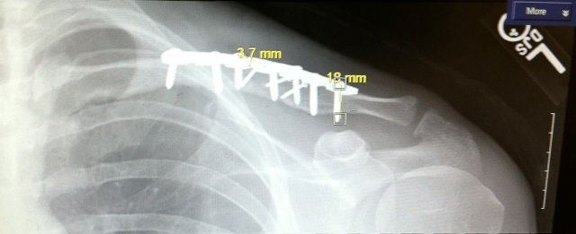 Standard frontal clavicle view