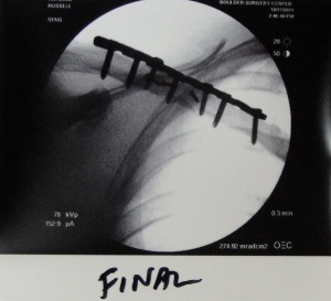 Clavicle after ORIF - plate & screws